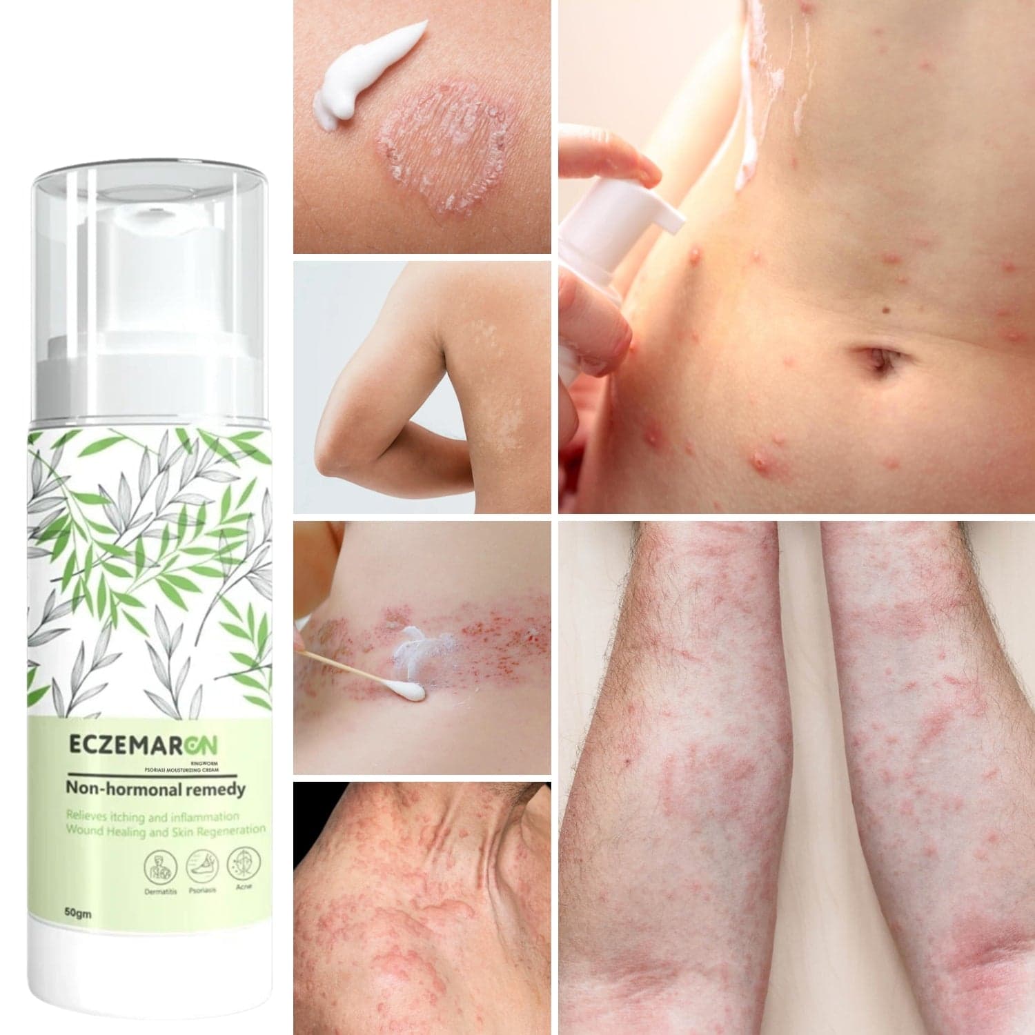 Eczemaron Moisturizer 50gm – Advanced Non-Hormonal Cream for Skin Irritation & Acne